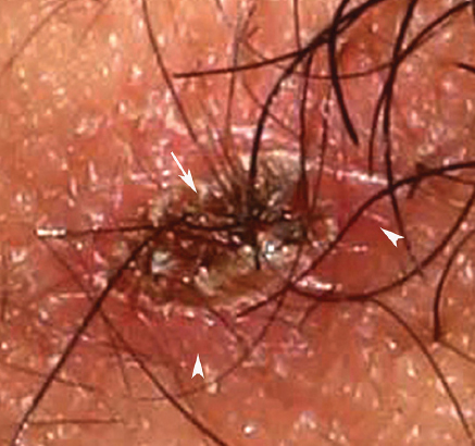 Black crusted eschar surrounded by an erythematous halo in the right axilla, a pathognomonic finding in the scrub typhus (arrows head).